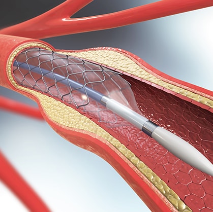 Coronary angioplasty and stents